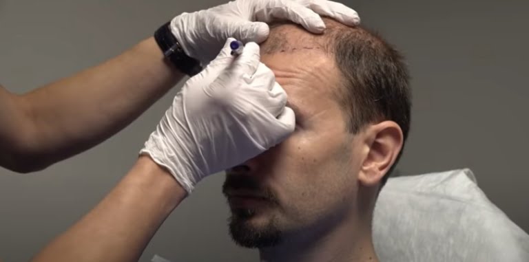 Türk saç ekimi klinikleri rotasını yurt dışına çevirdi