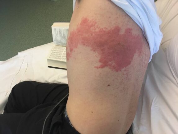 ZONA HASTALIĞINA KARŞI STRESTEN UZAK DURUN!