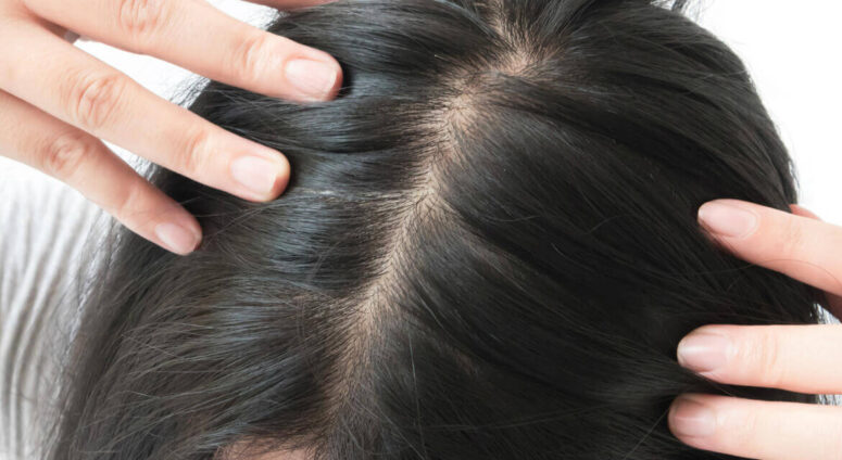 Saç dökülmesine kalıcı çözüm arayanlar saç ekimi merkezlerinin kapısını çalıyor