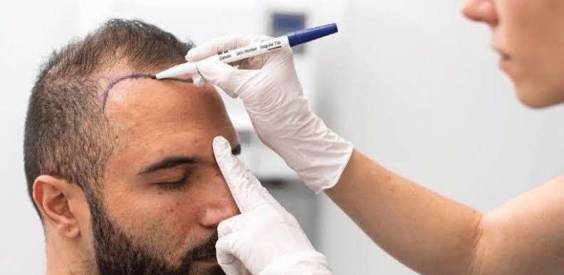 Türkiye saç ekiminde dünya lideri oldu