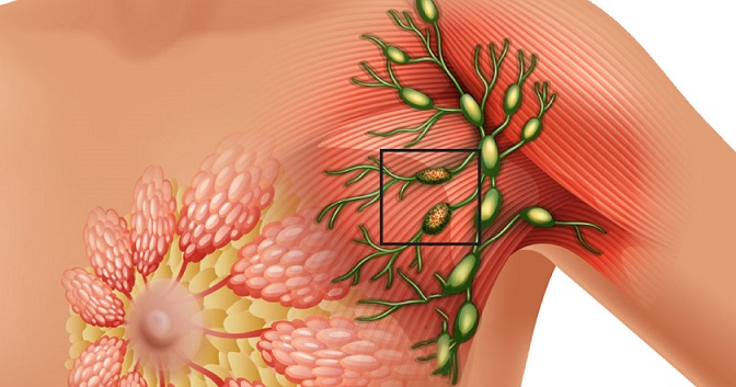 MEME KANSERİNİ YENEN HASTALAR BU KANSER TÜRÜ İLE KARŞI KARŞIYA!  “HER 6 AYDA BİR TAKİP EDİLMELİ”