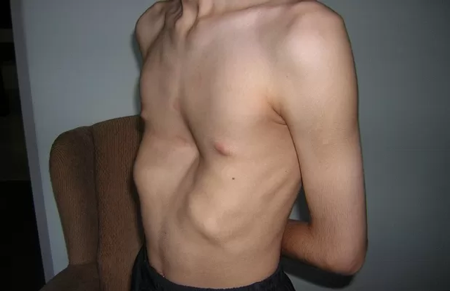 GÖĞÜS DUVARI ŞEKİL BOZUKLUKLARI ÖZGÜVEN KAYBINA YOL AÇMASIN