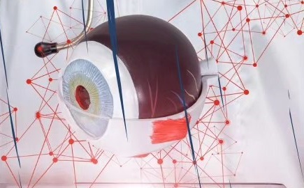 SARI NOKTAYA GÖZ İÇİ MERCEK TEDAVİSİ