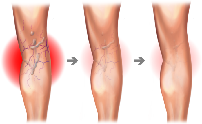 Varis Hastalığında Tedavi Yöntemleri