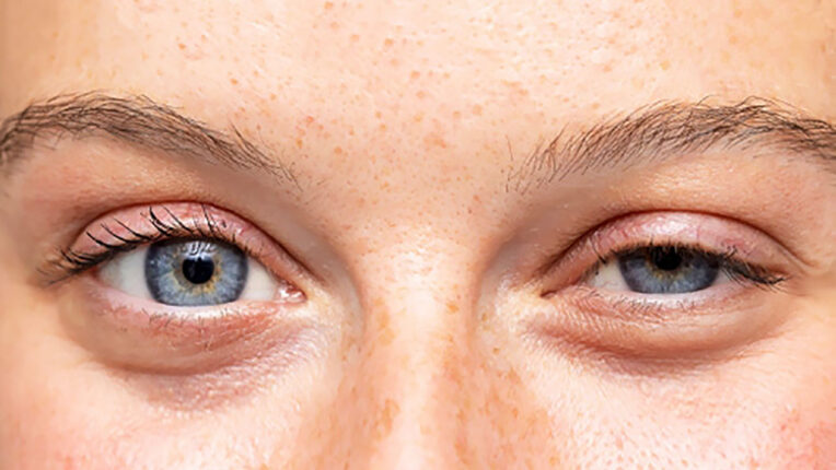 Düşük göz kapağı  kaderiniz değil!