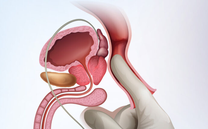 Prostatı Önlemek İçin Ne Yapmak Lazım?