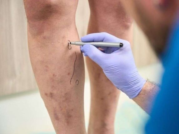 Varis Nedir? Nasıl Tedavi Edilir?